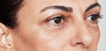 Restylane Before and After Gallery