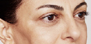 Restylane Before and After Gallery