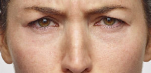 Restylane Before and After Gallery