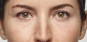 Restylane Before and After Gallery