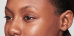 Restylane Before and After Gallery