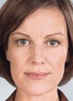 Sculptra Before and After Gallery