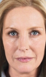 Sculptra Before and After Gallery