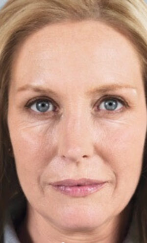 Sculptra Before and After Gallery