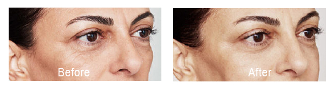 Skin booster before and after photo