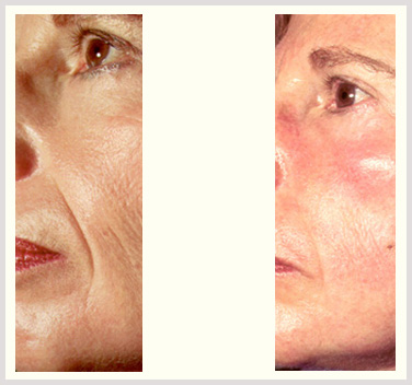 Fine Lines Treatment Edmonton