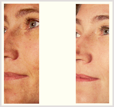 Melasma Treatment Edmonton