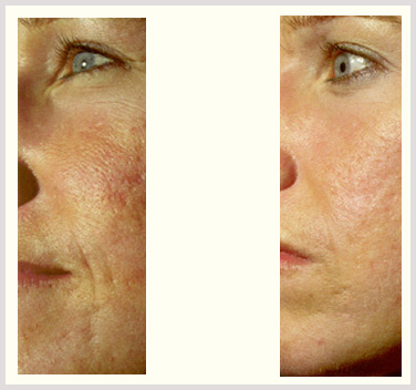 Texture Treatment Edmonton