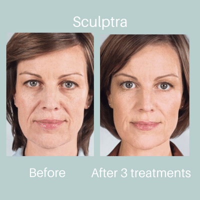 Sculptra Before & After Edmonton Canada