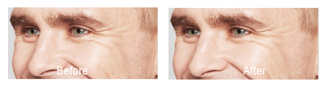 Skin booster before and after photo