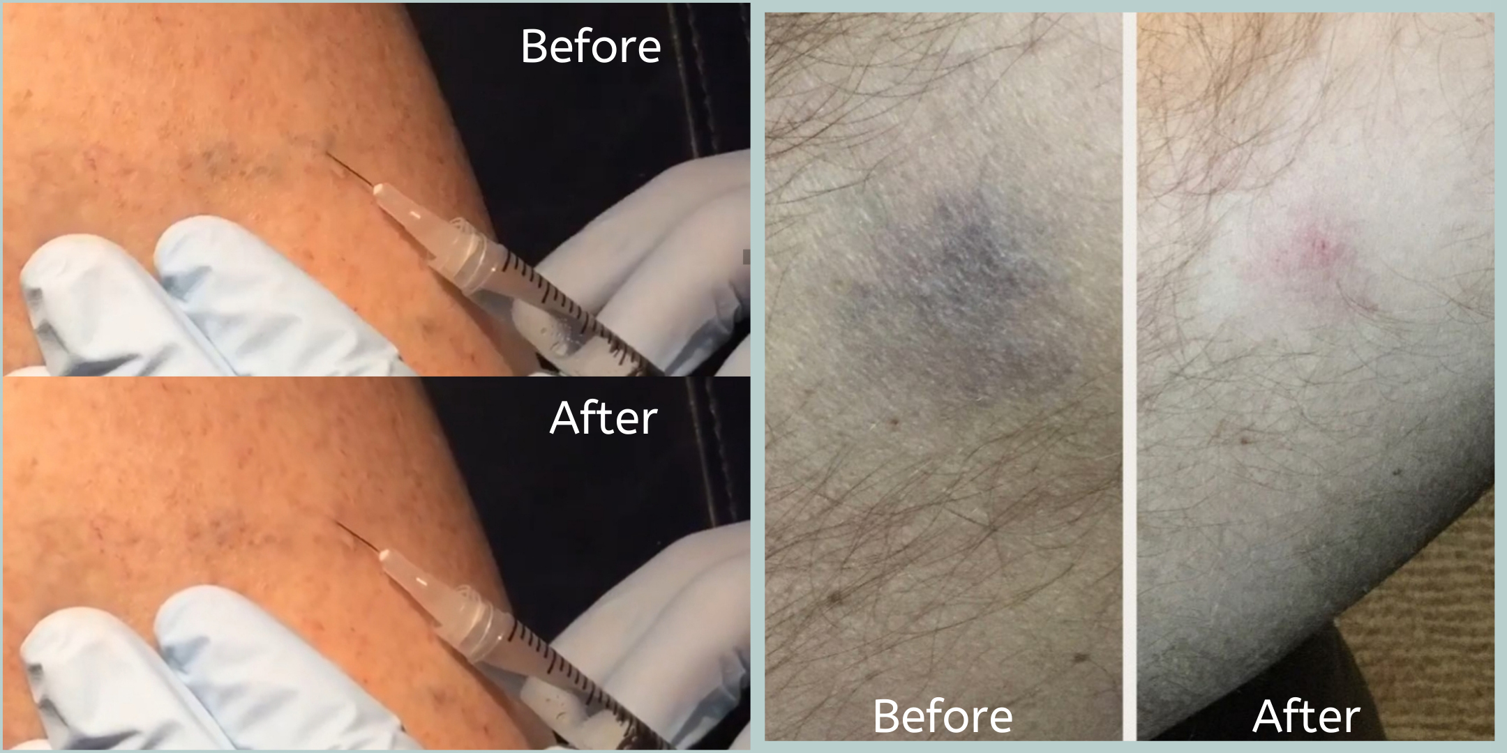 Spider Vein Removal